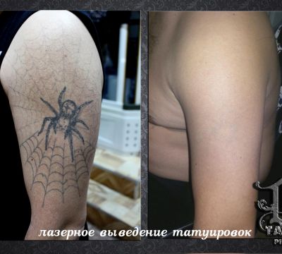 Лазерное удаление татуировок татуажа Алматы