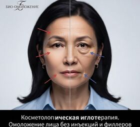 Иглотерапия для лица &mdash; Алматы | Иглотерапевт косметолог женщина  