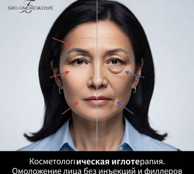 Иглотерапия для лица — Алматы | Иглотерапевт косметолог женщина  
